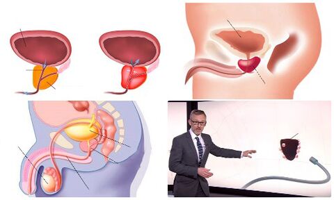 malusog at may sakit na prostate